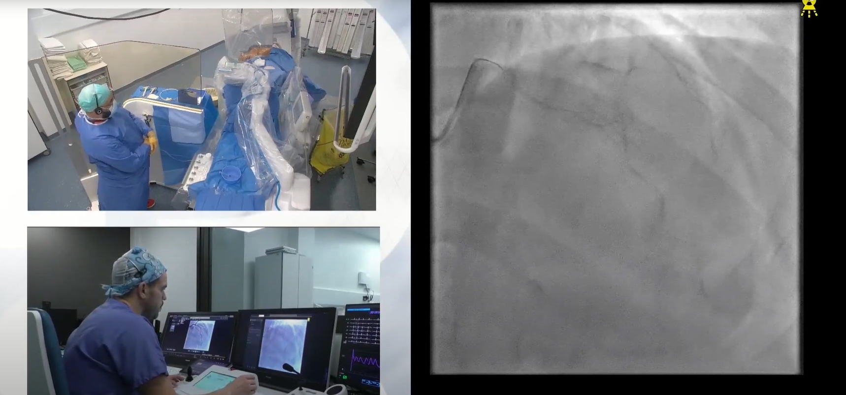 Bifurcation robotisée angioplastie coronaire